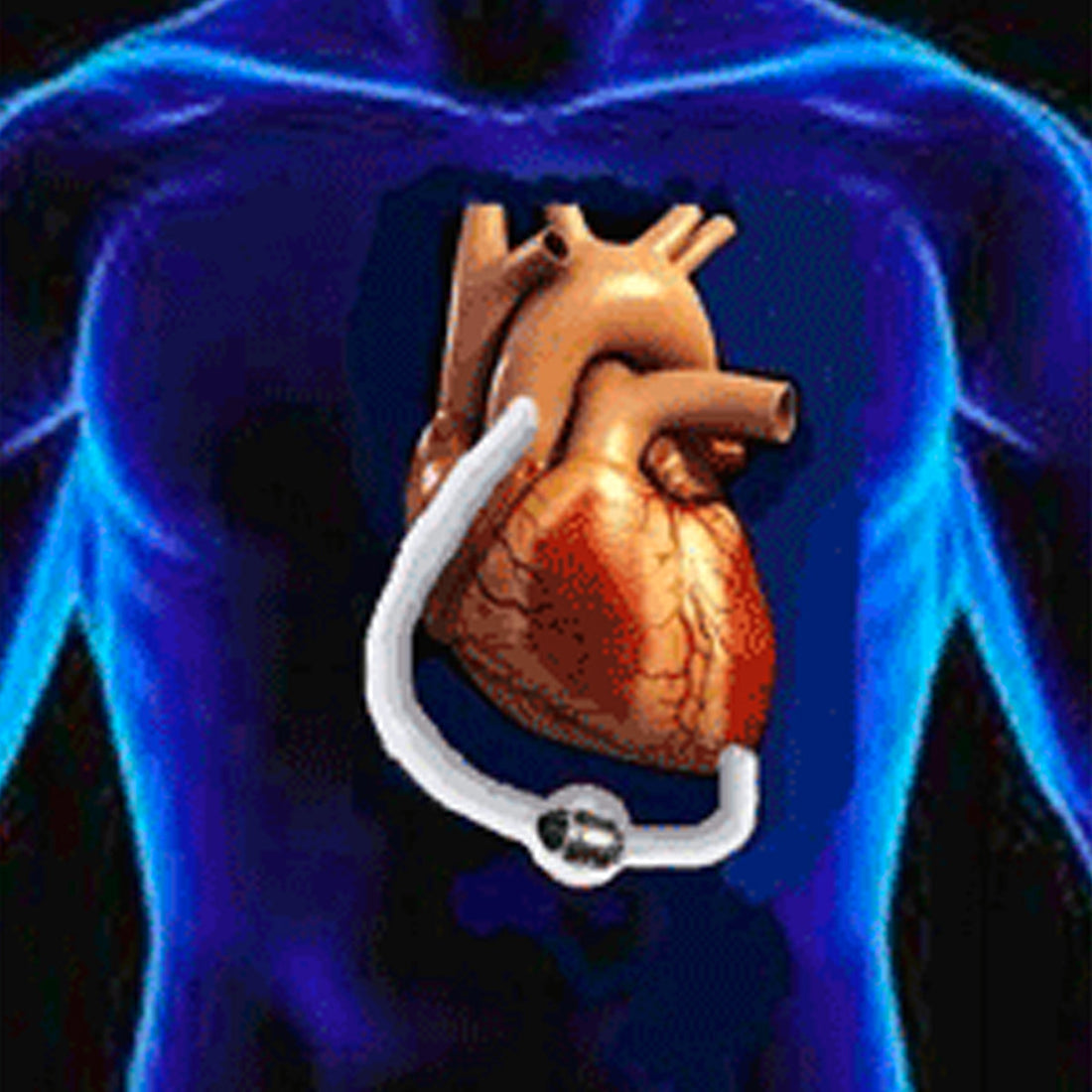 Refining Auscultation of Left Ventricular Assist Devices: Insights From Phonocardiography